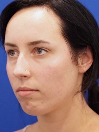 Chin Implant and Upper Lip Filler* — Before