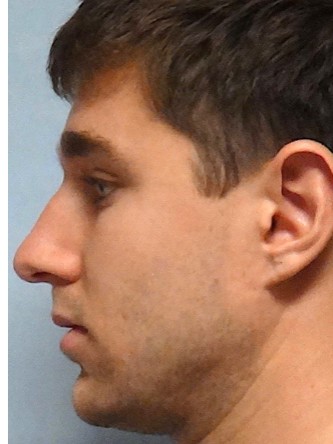 Crooked Nose & Dorsal Hump2* — Before