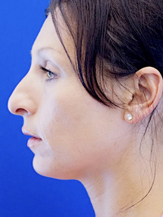 Downturn Tip Endonasal Rhinoplasty — Before