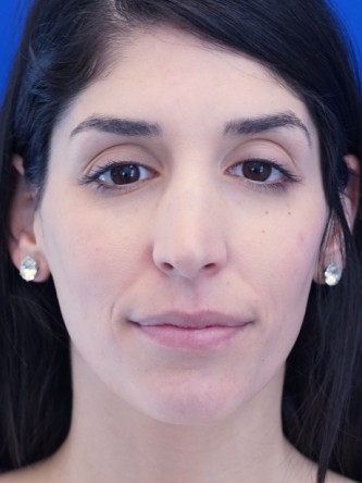 Nasal Bridge Bump* — Before