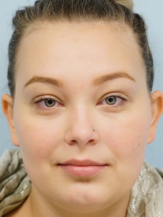 Restylane Silk Achieves Voluptuous Lips* — Before