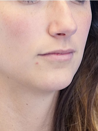 One Year Lip Filler Result — Before