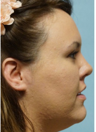 Crooked Nose Endonasal Technique2* — After