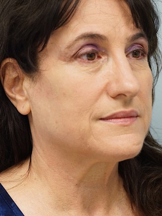 Mini Face and Neck Lift* — Before