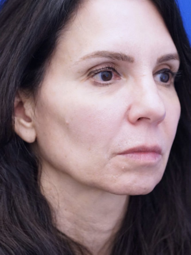 Deep Plane Jowl Lifting — Before