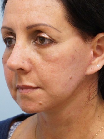 Aging Eyelid Rejuvenation, Facelift, Necklift 2* — After