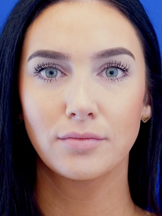 Nasal Hump Closed Rhinoplasty — After