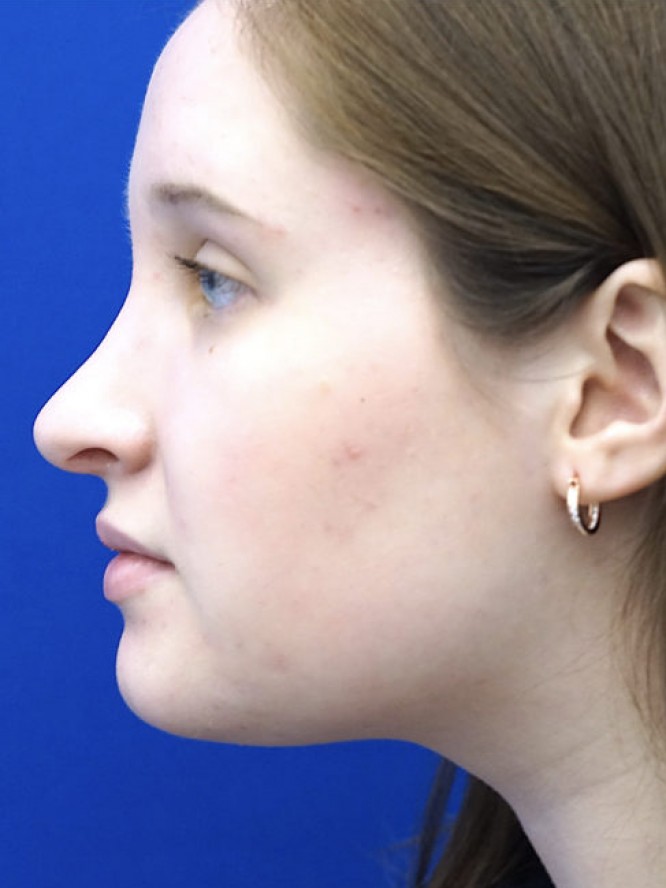 Reduction Dorsal Hump — After