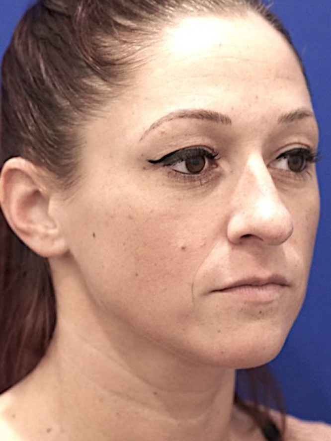 Dainty Nose — Before