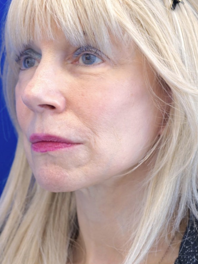 Crisp Jaw and Neck Lines — After