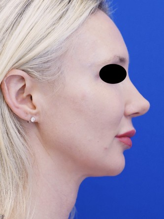 Finesse Tip Rhinoplasty — After