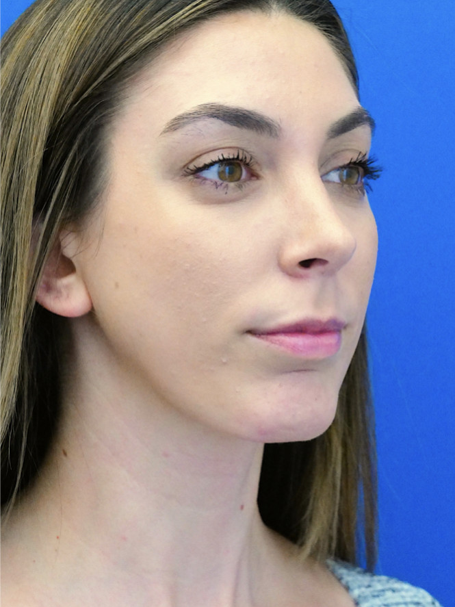 Facial Profile Balance — After