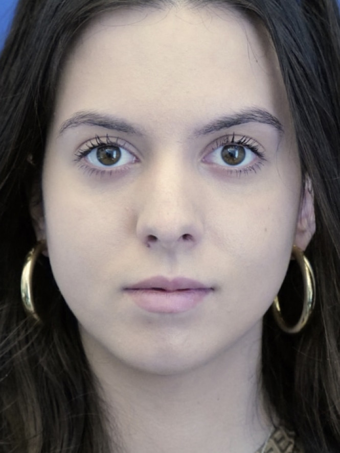 Preservation Rhinoplasty2 — Before