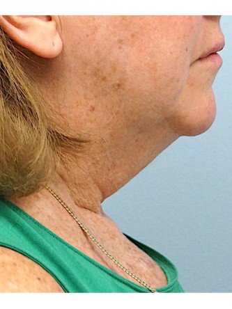 Short Oblique Neck* — Before