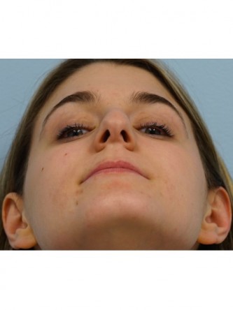 Droopy Tip Endonasal Rhinoplasty* — Before