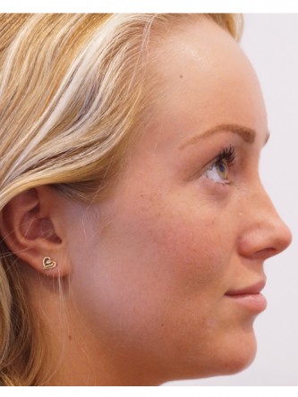 Restylane Silk to Upper & Lower Lips* — Before