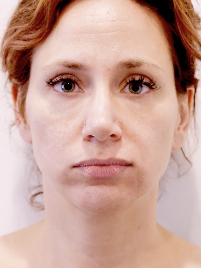 Under Eye Filling — After