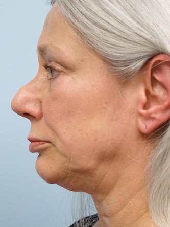 Over Projected Thick Skin Nose* — Before