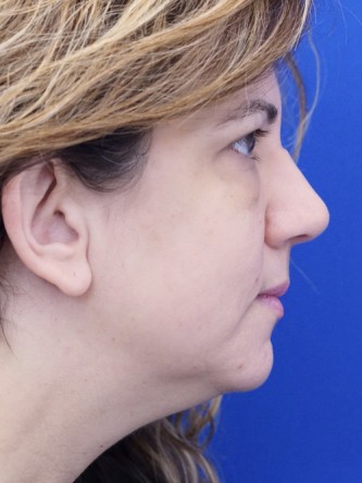 Extended Lower Blepharoplasty* — Before