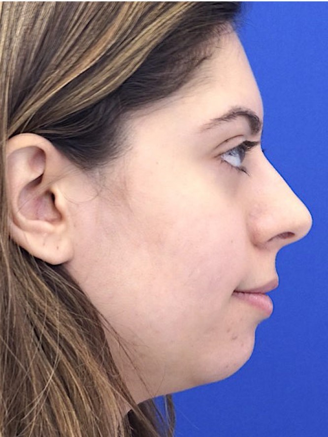 Hump Reduction and Chin Projection — Before