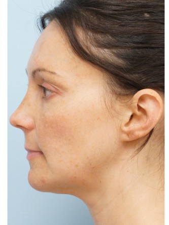 Fractional CO2 Laser Skin Resurfacing2* — Before