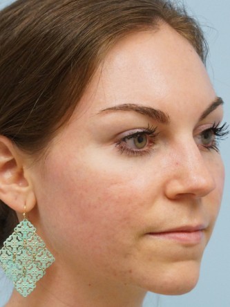 Fractional CO2 Laser Skin Resurfacing1* — After