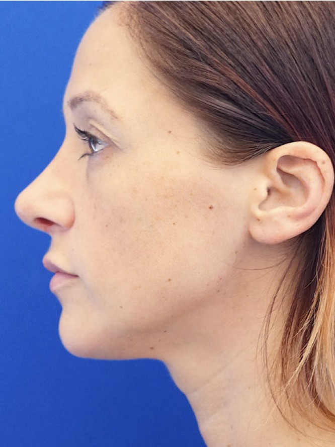 Dainty Nose — After