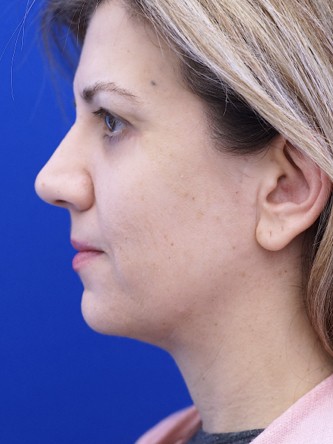Refined Neck Line* — After