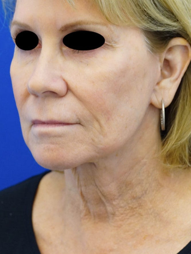 Secondary Deep Plane Facelift — Before