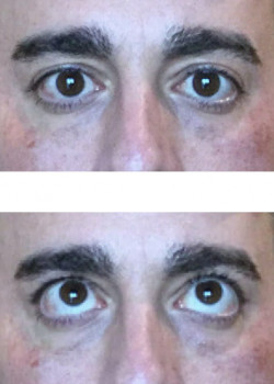 Same Day Tear Trough Result — After
