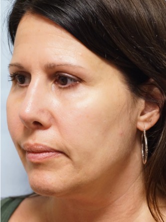 Tip Asymmetry and Hanging Columella* — After