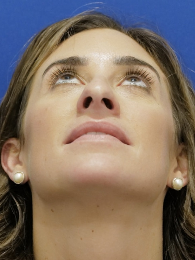 Preservation Rhinoplasty — Before