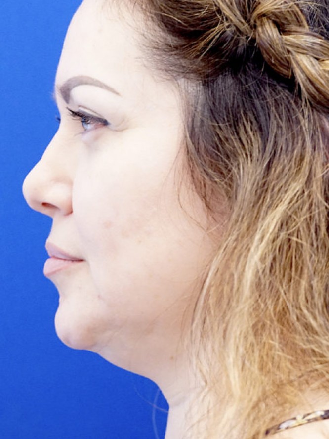 Nasal Tip Asymmetry — Before