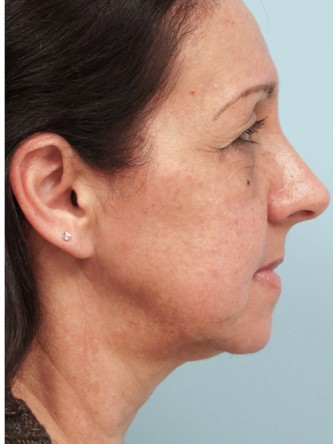 Aging Eyelid Rejuvenation, Facelift, Necklift 2* — Before