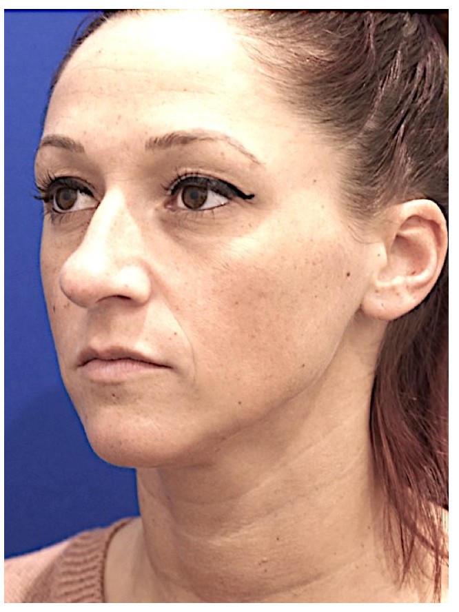 Dainty Nose — Before