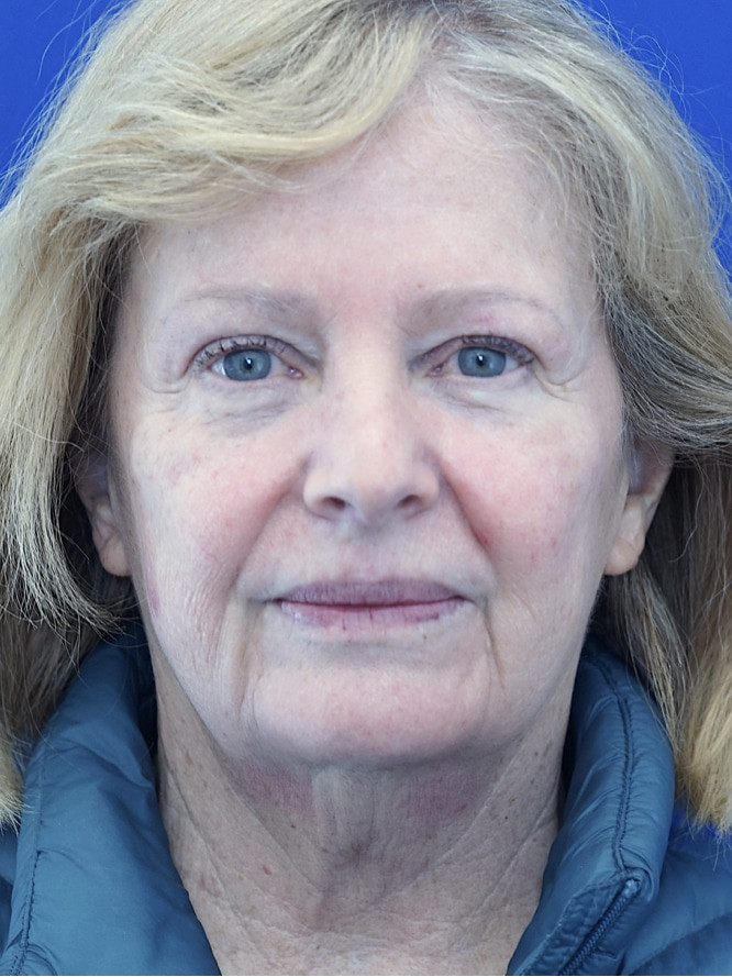 Deep Plane Jowl and Neck Lift — Before