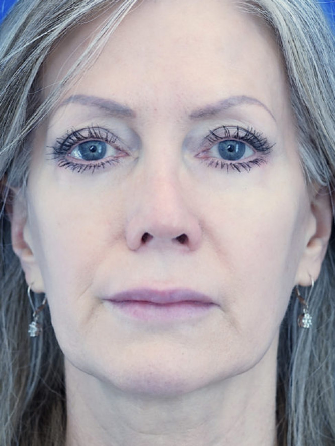 Upper Lip Fullness — Before