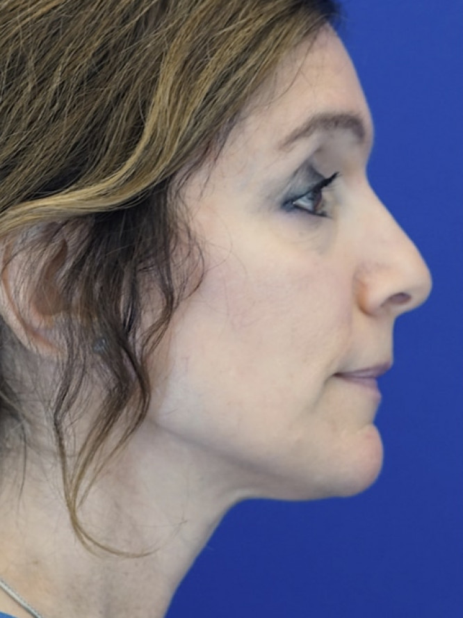 Endonasal Subtlety — Before