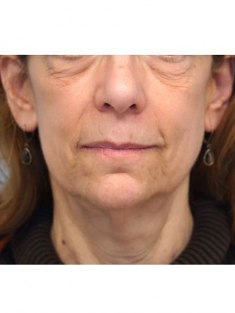 Full Face and Necklift, Upper and Lower Eyelid, Browlift* — Before