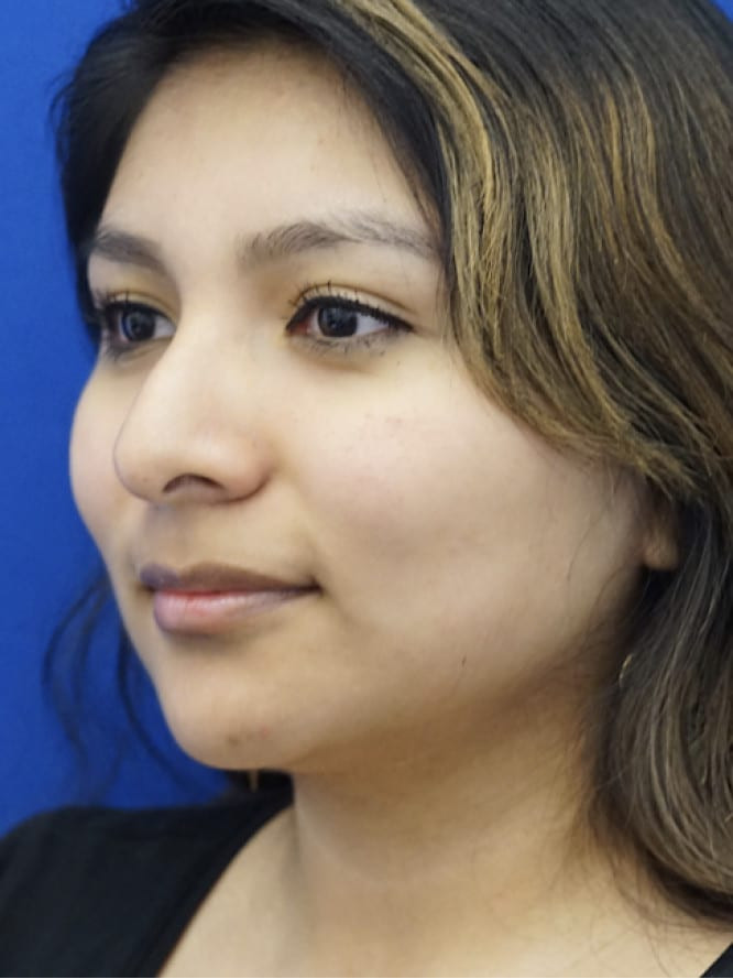 Droopy Nasal Tip — Before