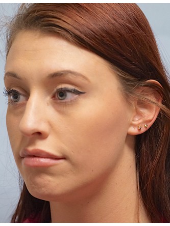 Cupid’s Bow Enhancement by Juvederm* — After