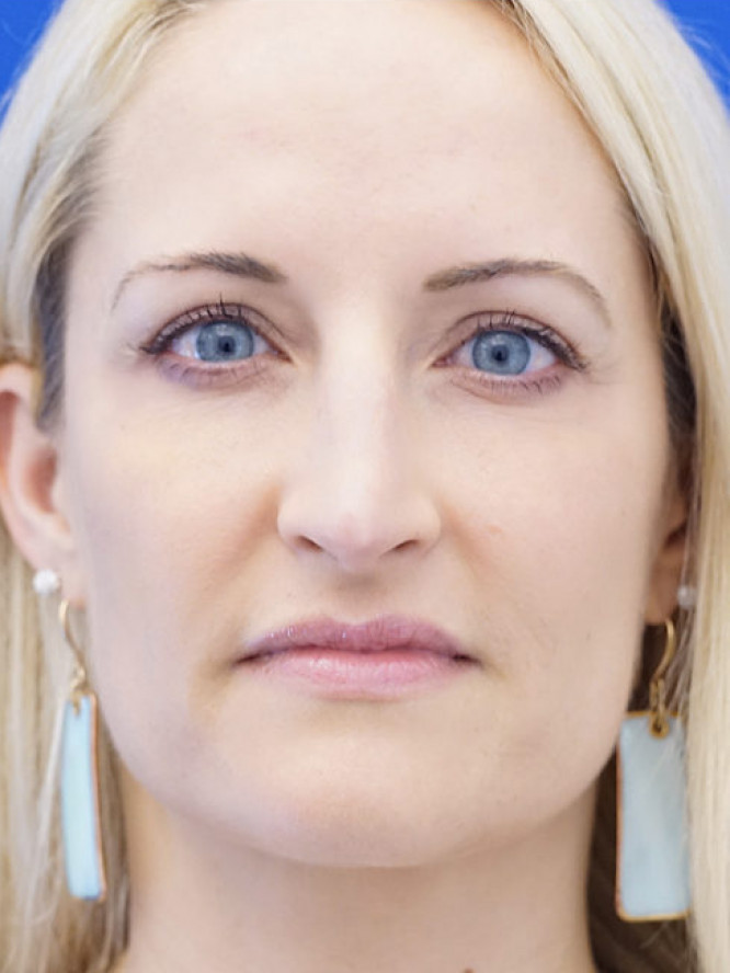 Nasal Profile Finesse — Before