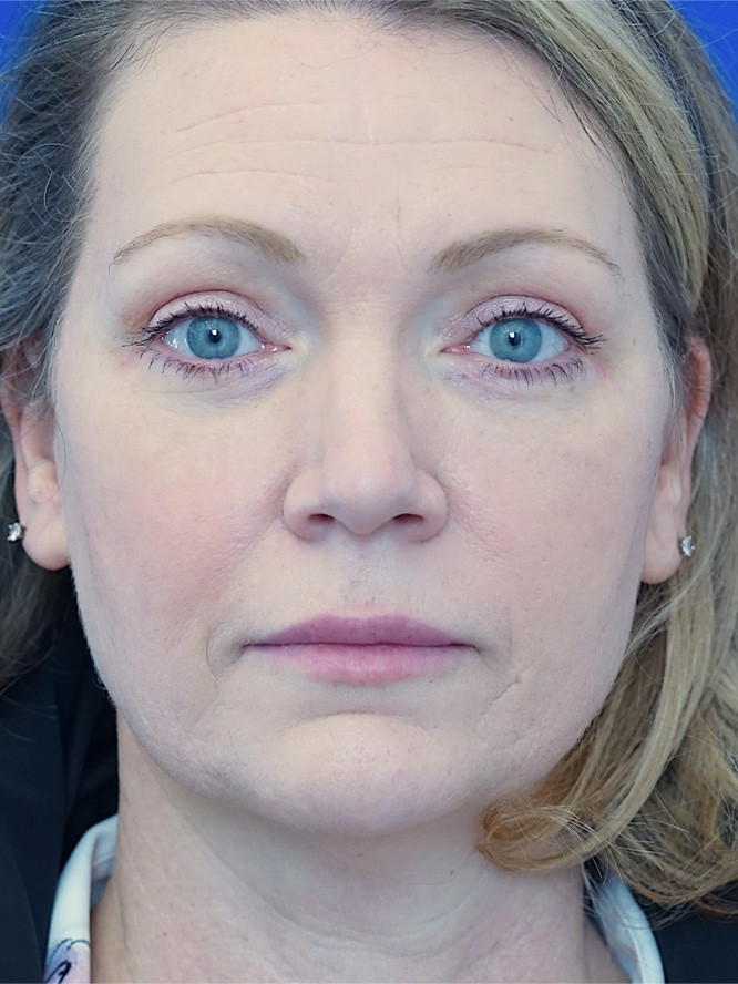 Cosmetic Eyelid Surgery — After