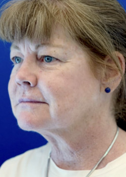 Surgical Neck Lift — Before