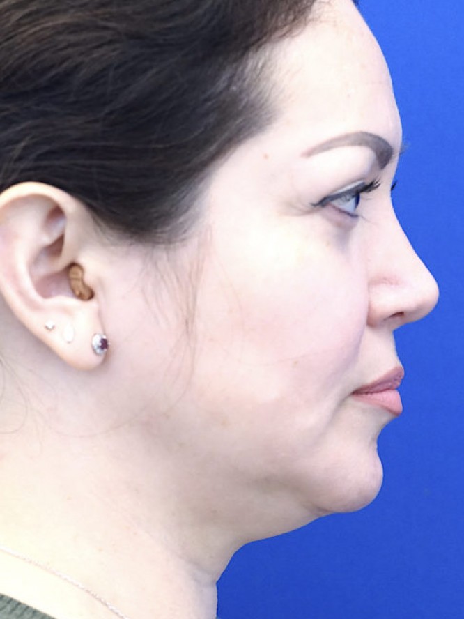 Nasal Tip Asymmetry — After