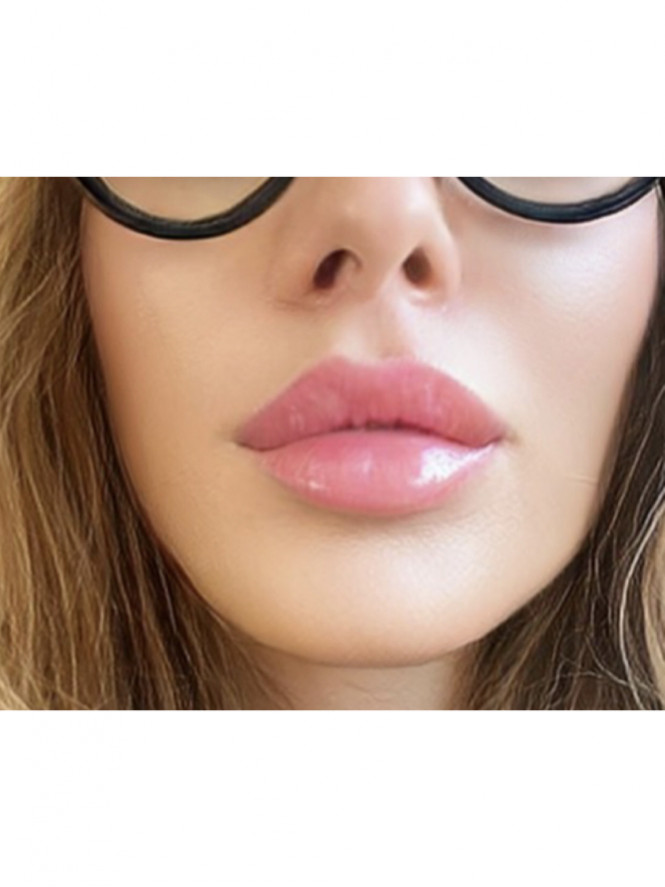 Voluminous Lips — After