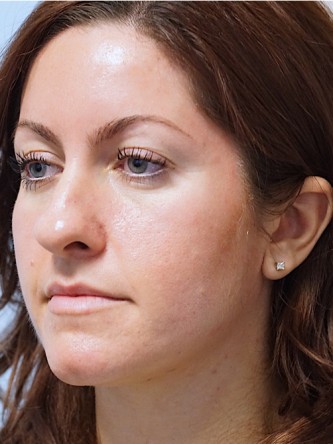 Boxy Tip Endonasal Rhinoplasty* — Before