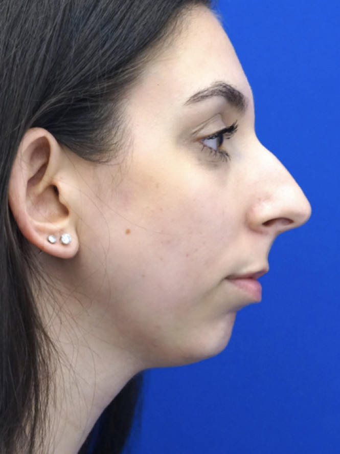 Facial Profile Balance — Before