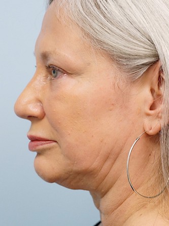 Over Projected Thick Skin Nose* — After