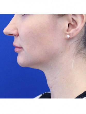 Finesse Tip Rhinoplasty — Before